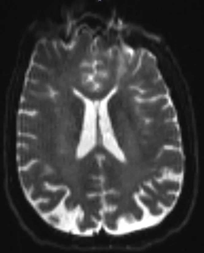 MRI · Brain
