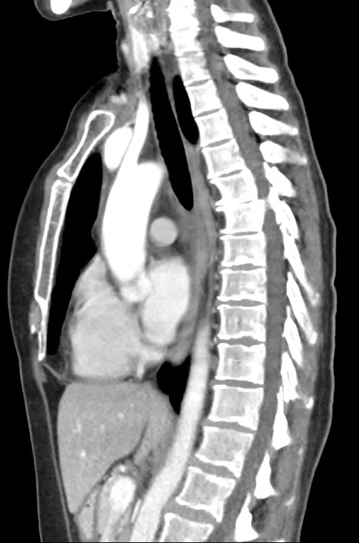 CT · Spine