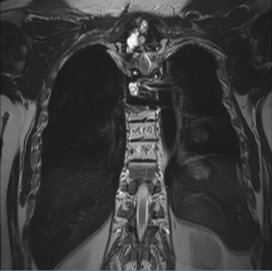 MRI · Thorax